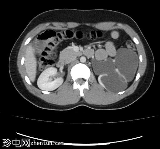 肾盂输尿管连接部梗阻