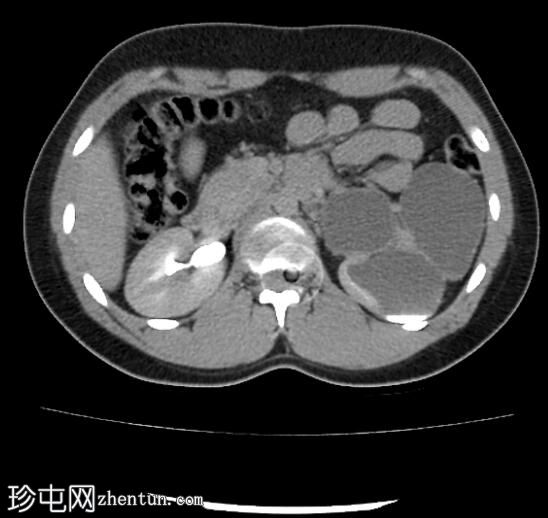 肾盂输尿管连接部梗阻