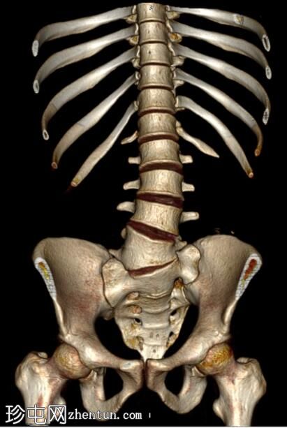腰椎半椎体和交叉融合肾异位