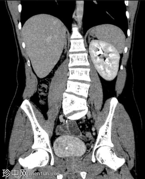 腰椎半椎体和交叉融合肾异位