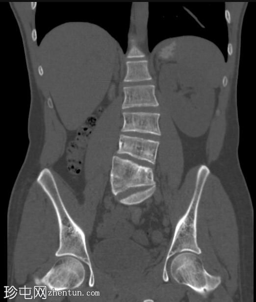 腰椎半椎体和交叉融合肾异位