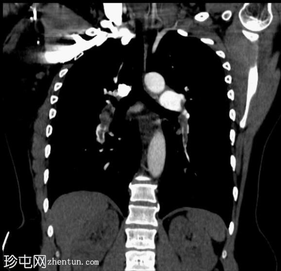 慢性肺栓塞引起的肺动脉高压