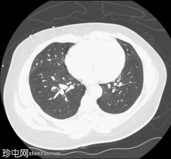 慢性肺栓塞引起的肺动脉高压