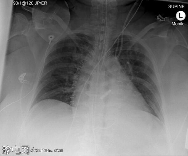 胸部 X 光检查中导管和导管的放置位置不佳