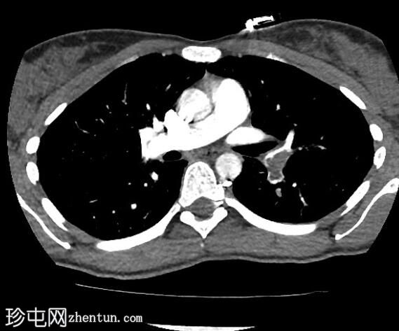 肺栓塞和肺梗死伴汉普顿驼峰