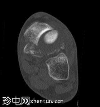 舟骨骨折脱位
