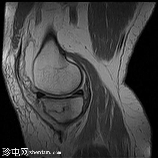 胫骨近端应力性骨折