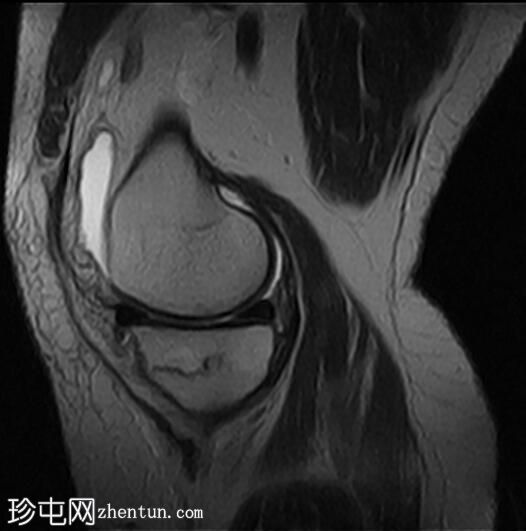 胫骨近端应力性骨折