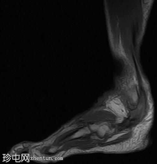 腓骨短肌腱纵向劈裂撕裂