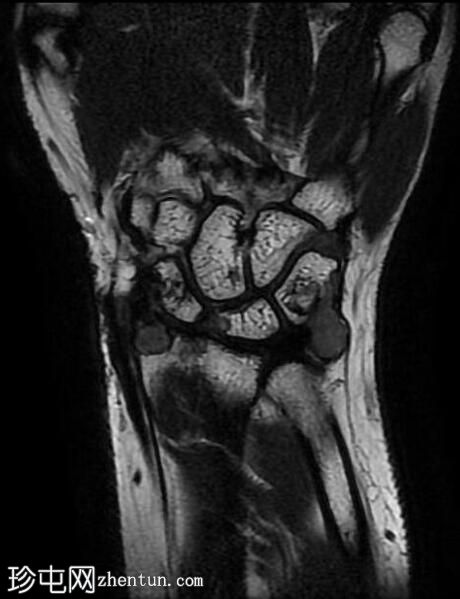 腱鞘巨细胞瘤 - 手腕