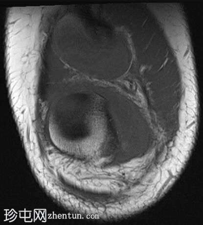 髌骨外侧脱位伴大骨软骨碎片