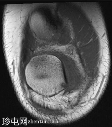 髌骨外侧脱位伴大骨软骨碎片