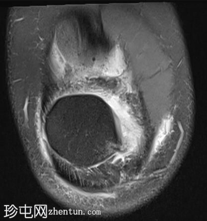 髌骨外侧脱位伴大骨软骨碎片