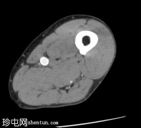 软组织脂肪瘤——大腿