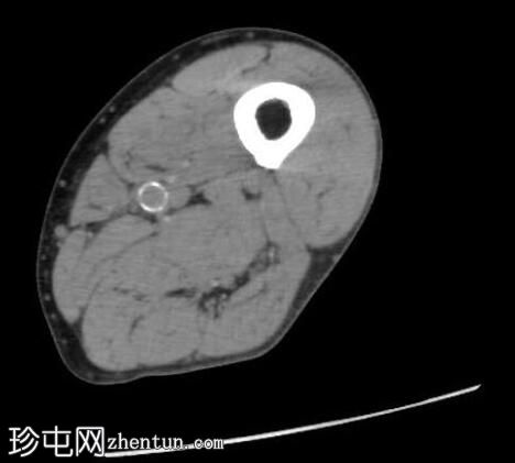 软组织脂肪瘤——大腿