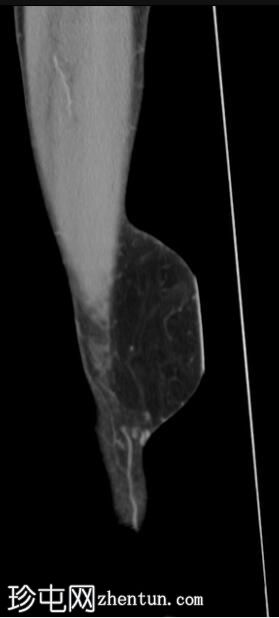 软组织脂肪瘤——大腿