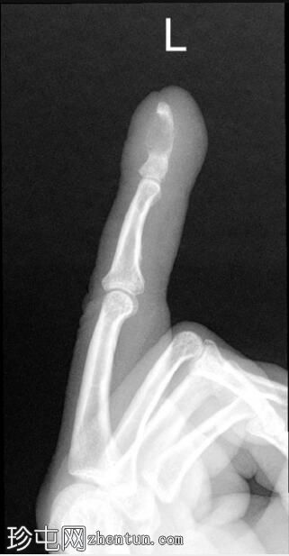 内生软骨瘤 - 远端指骨
