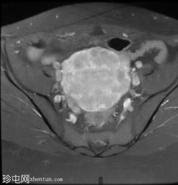 弥漫性子宫平滑肌瘤病