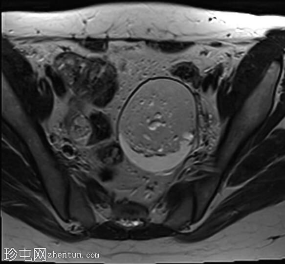 卵巢成熟囊性畸胎瘤