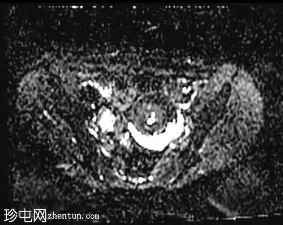 卵巢成熟囊性畸胎瘤
