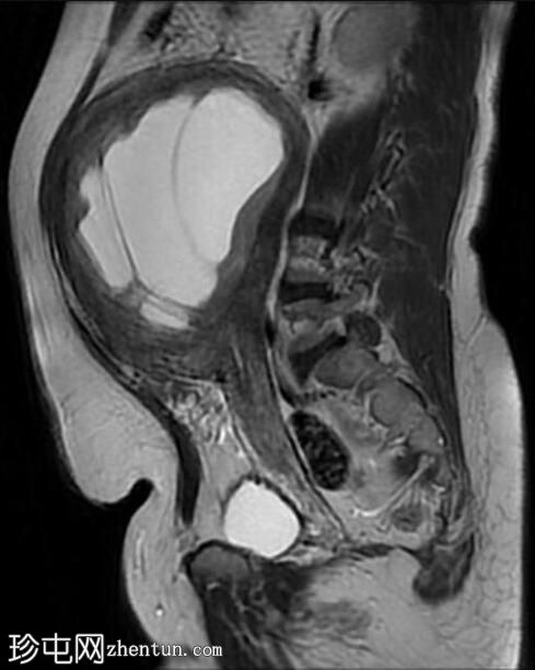 巨大子宫肌瘤伴囊性变