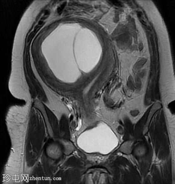 巨大子宫肌瘤伴囊性变