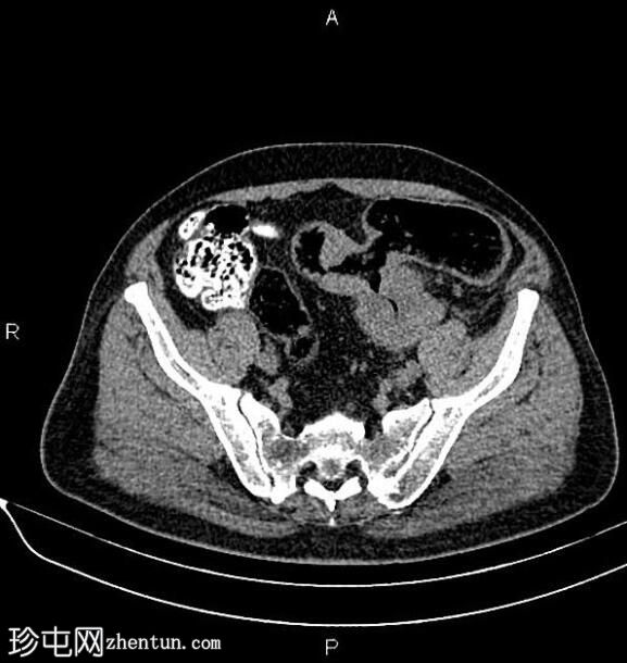 溃疡性结肠炎患者的结肠腺癌