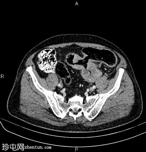 溃疡性结肠炎患者的结肠腺癌