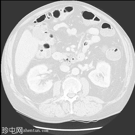 阑尾炎和阑尾结石