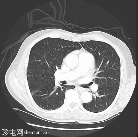 阑尾炎伴有局部穿孔和脓肿形成