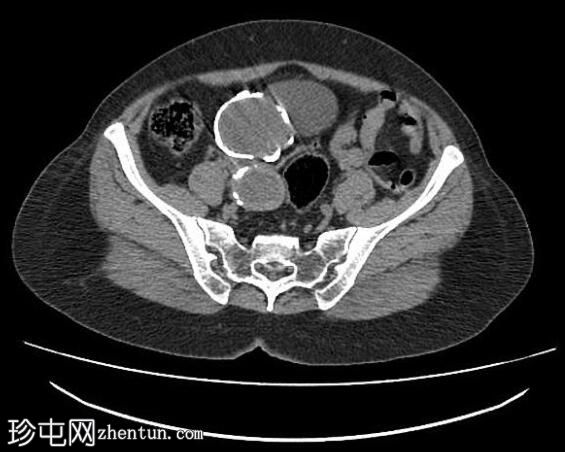 钙化的肝和盆腔包虫囊肿