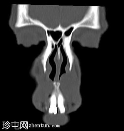 鼻唇沟囊肿