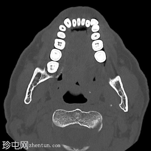 下颌环面骨髓炎