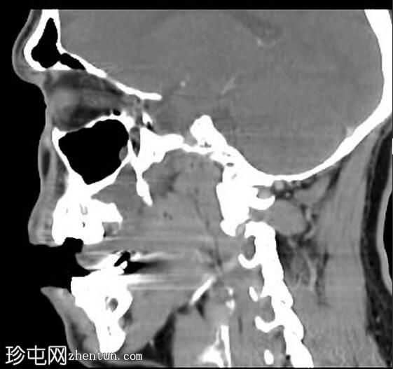 牙源性纤维粘液瘤 - 上颌骨