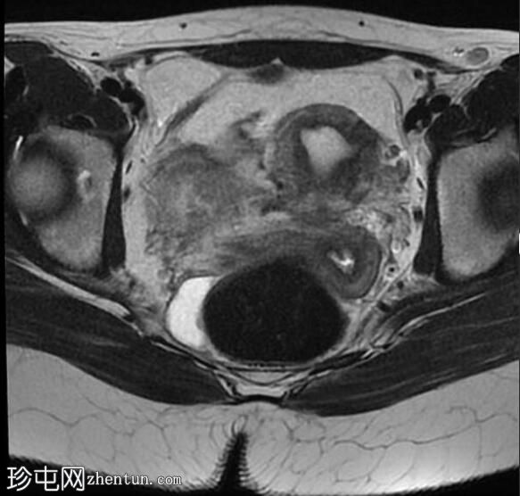 卵巢交界性粘液性囊腺瘤