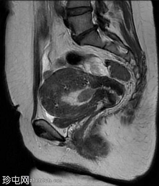 弥漫性子宫腺肌症