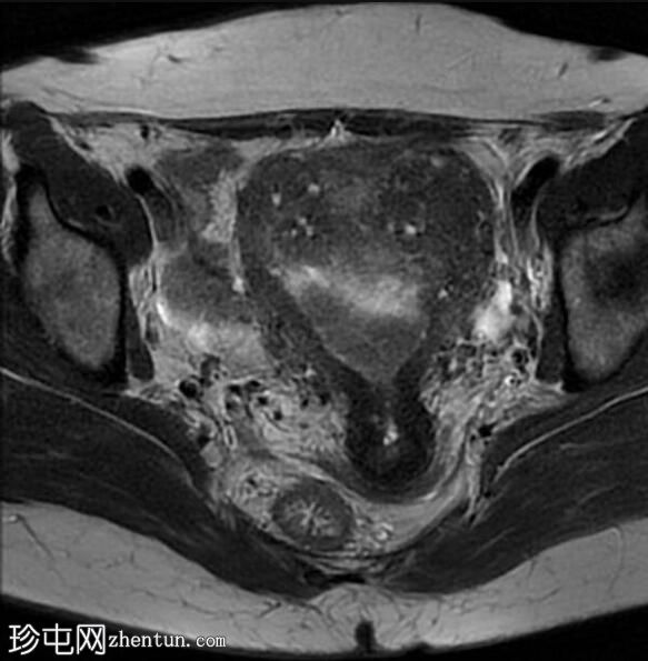 弥漫性子宫腺肌症