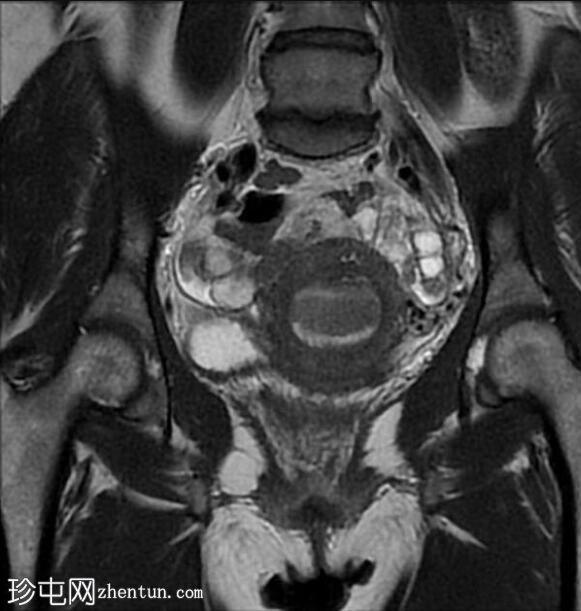 弥漫性子宫腺肌症