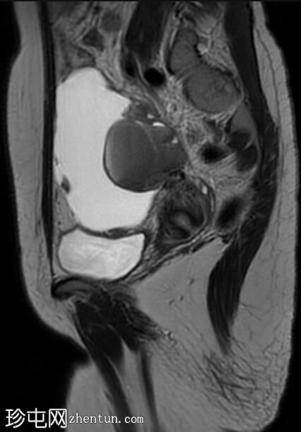 子宫内膜异位囊肿和腹膜包涵体囊肿