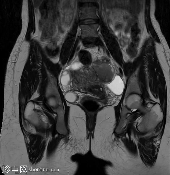 子宫内膜异位囊肿和腹膜包涵体囊肿