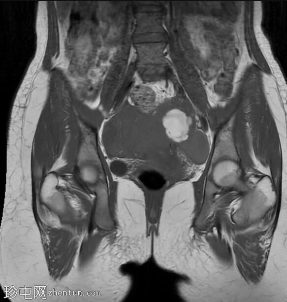 子宫内膜异位囊肿和腹膜包涵体囊肿