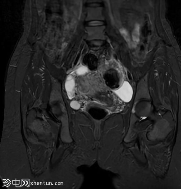 子宫内膜异位囊肿和腹膜包涵体囊肿