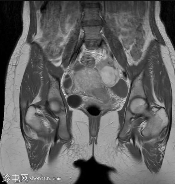 子宫内膜异位囊肿和腹膜包涵体囊肿