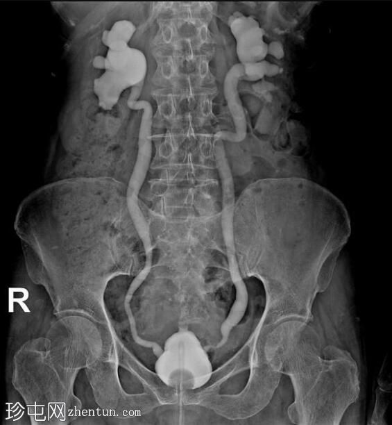 梨形膀胱伴膀胱输尿管反流