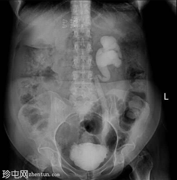 神经源性膀胱伴膀胱输尿管反流