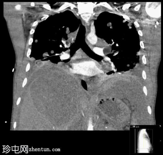 睾丸肿瘤转移至肺和淋巴结