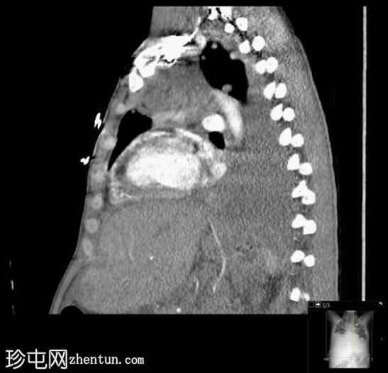 睾丸肿瘤转移至肺和淋巴结