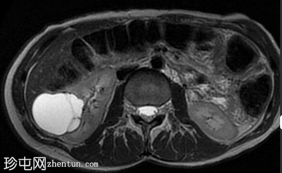 肾囊肿 - 波斯尼亚克 II 级