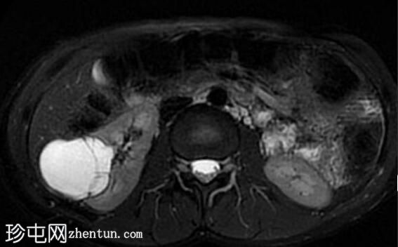 肾囊肿 - 波斯尼亚克 II 级