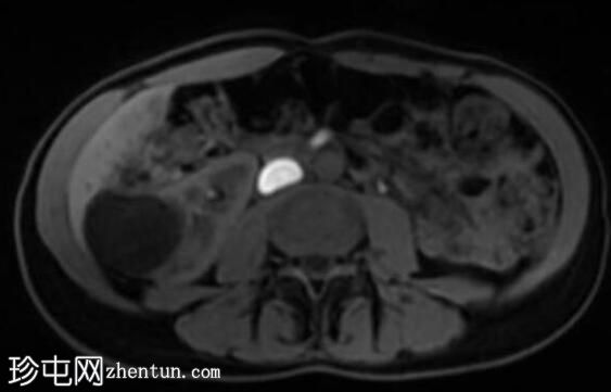 肾囊肿 - 波斯尼亚克 II 级